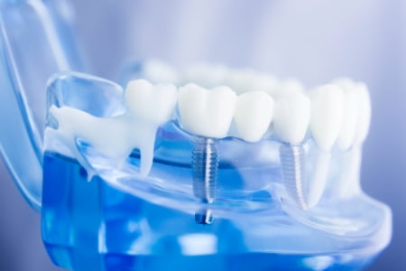 根管治療（歯内療法）の重要性 – 世田谷区の根管治療 (歯内療法