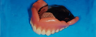 義歯(入れ歯)治療
